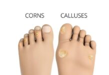 Soft Corn vs. Callus What’s the Difference and How Do You Treat Them?